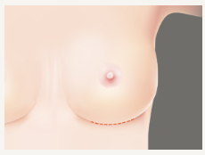 가슴보형물 모티바, 멘토, 세빈 차이 <봉봉성형외과> 관련 이미지 6