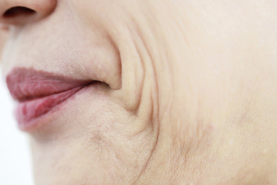 노안 팔자주름 원인 안면거상술 효과 관련 이미지 2