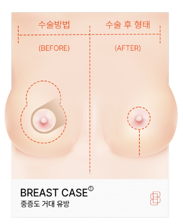 크고 처진 가슴도 가슴축소수술로 나에게 맞는 크기로 - 봉봉성형외과 관련 이미지 6