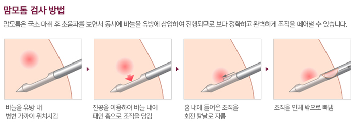 유방암도 봉봉성형외과 유방클리닉에서 맘모톰시술로~ 관련 이미지 4