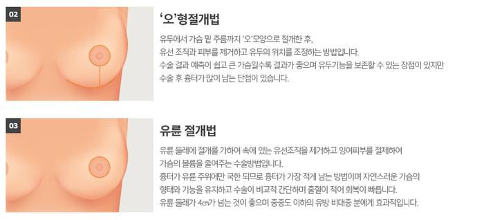 가슴축소술후기, 가슴성형수술잘하는곳 봉봉성형외과에서 확인~ 관련 이미지 4