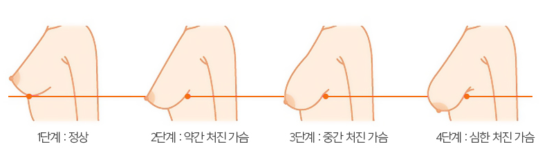 처진가슴교정, 봉봉성형외과 가슴거상술을 통해 콤플렉스 개선~! 관련 이미지 3