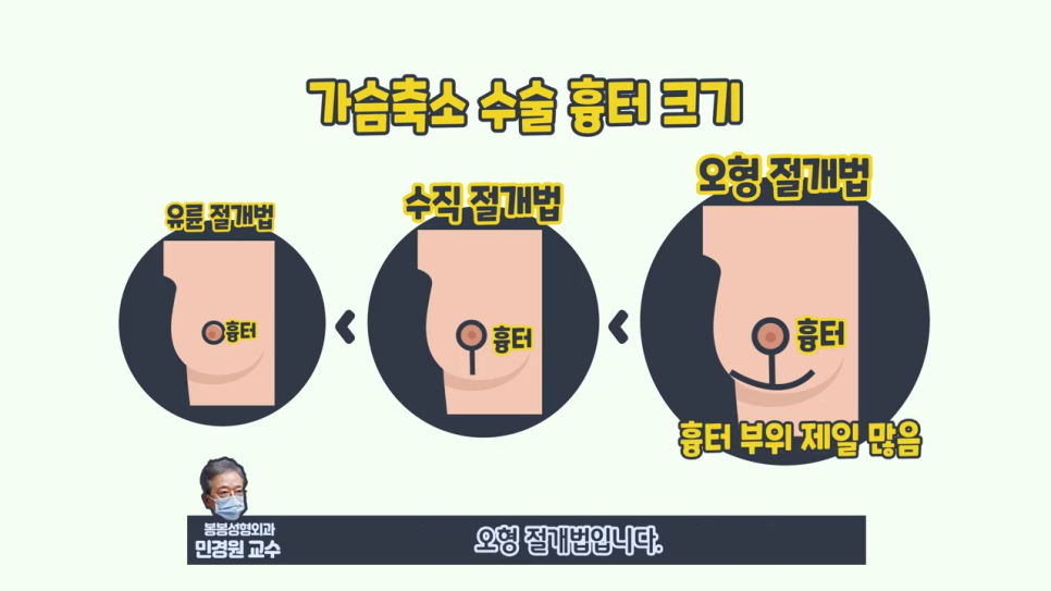 가슴축소수술후기 보니 절개 방법이 3가지던데 관련 이미지 5