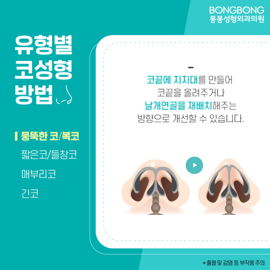 보형물과 자가조직을 더한 봉봉 하이브리드코성형수술이란? 관련 이미지 4