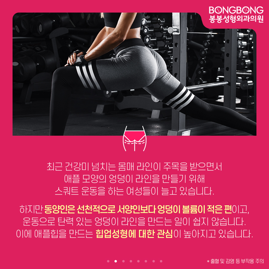 하이브리드 힙업성형방법, 세계최초 개발한 봉봉성형외과 관련 이미지 2