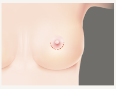 가슴보형물 모티바, 멘토, 세빈 차이 <봉봉성형외과> 관련 이미지 7