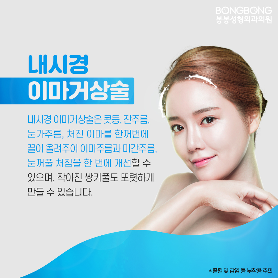 내시경이마거상술 효과는? 관련 이미지 5