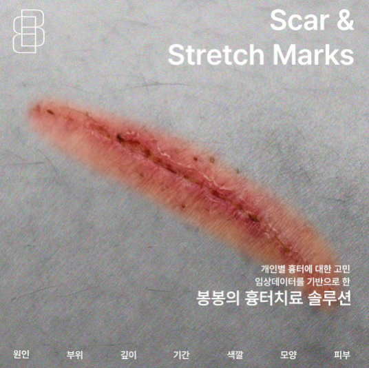 흉터레이저치료 튼살 피부재생 탄력까지! 강남 #봉봉성형외과 관련 이미지 3