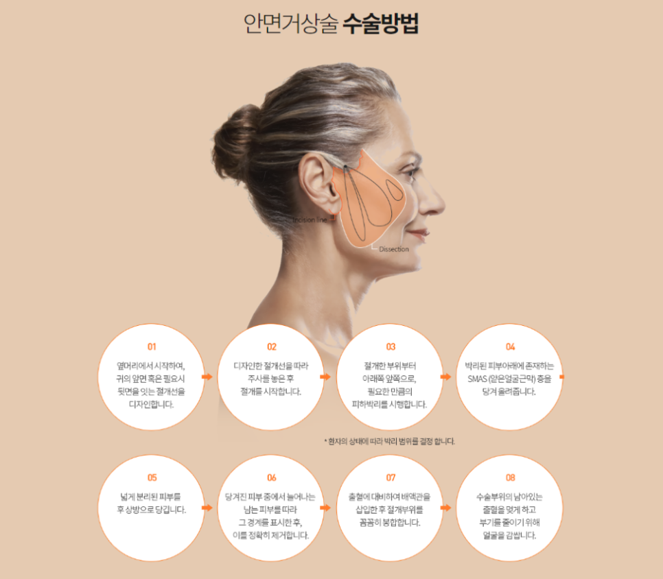 부모님효도선물로 인기있는 안면거상술! 효과 및 수술방법은? 관련 이미지 7