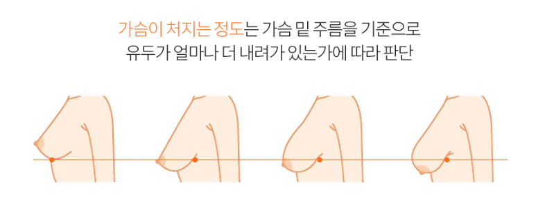 출산 후 처지고 작아진 가슴 고민, 가슴거상술로 고민해결! by.봉봉성형외과 관련 이미지 3