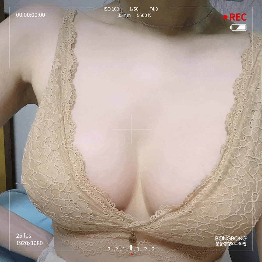 절벽가슴수술 부작용 가격 효율 따진다면 #하이브리드가슴성형 관련 이미지 4