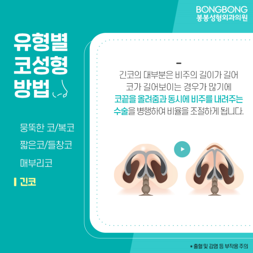 보형물과 자가조직을 더한 봉봉 하이브리드코성형수술이란? 관련 이미지 7