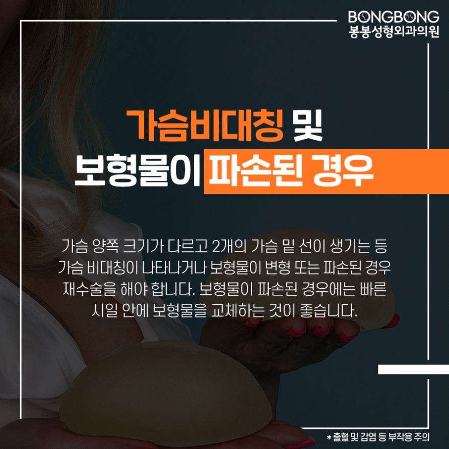 가슴성형 후 구형구축 [가슴재수술] 고려사항은? 관련 이미지 5
