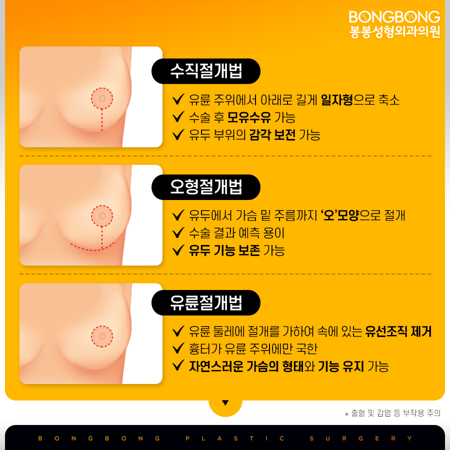 가슴축소수술후기 후회없는 선택을 위해 관련 이미지 4