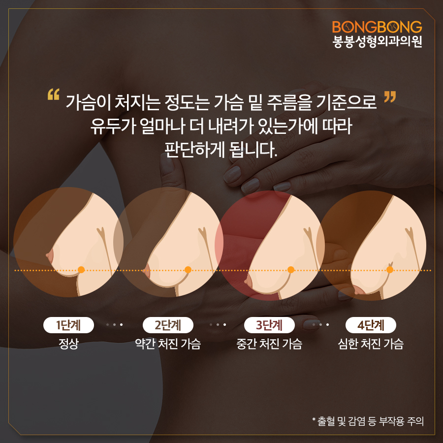 처진가슴올리기 가슴거상술 잘하는곳 봉봉! 관련 이미지 3