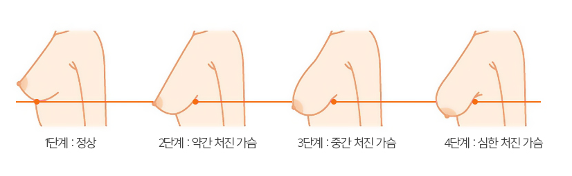 처진가슴교정 가슴거상수술 콤플렉스 개선은 어디서? 관련 이미지 3