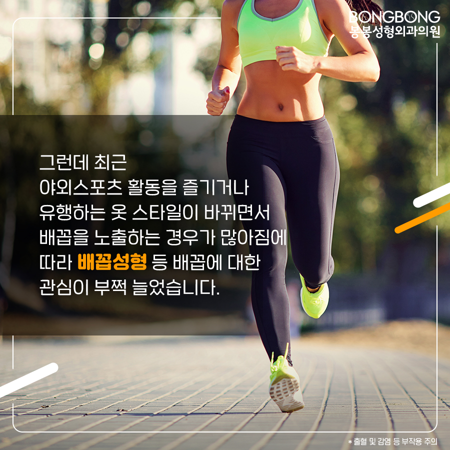 참외배꼽 콤플렉스라면 봉봉성형외과의 배꼽성형 관련 이미지 3