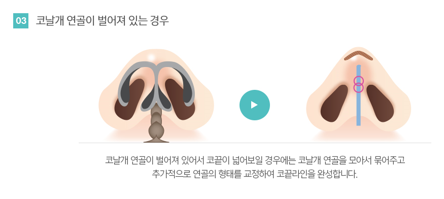 코끝성형후기 오똑한 콧날의 봉봉성형외과에서~ 관련 이미지 7