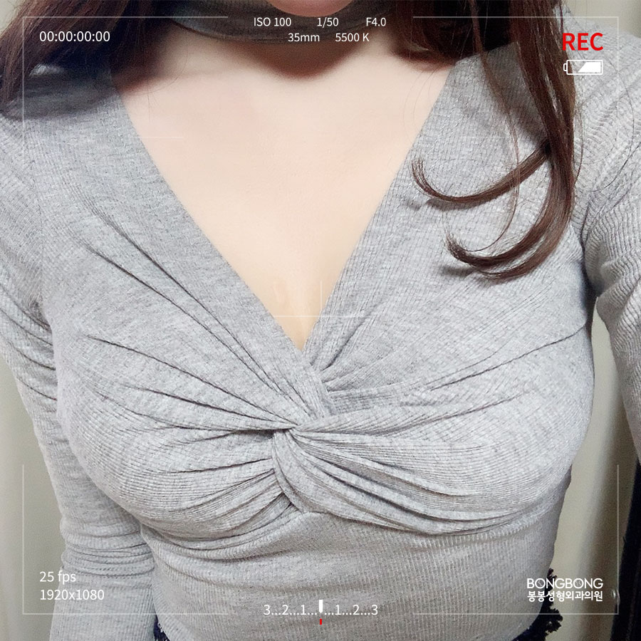 모티바 이용한 하이브리드 가슴성형 어떤 기대 효과가? 관련 이미지 6
