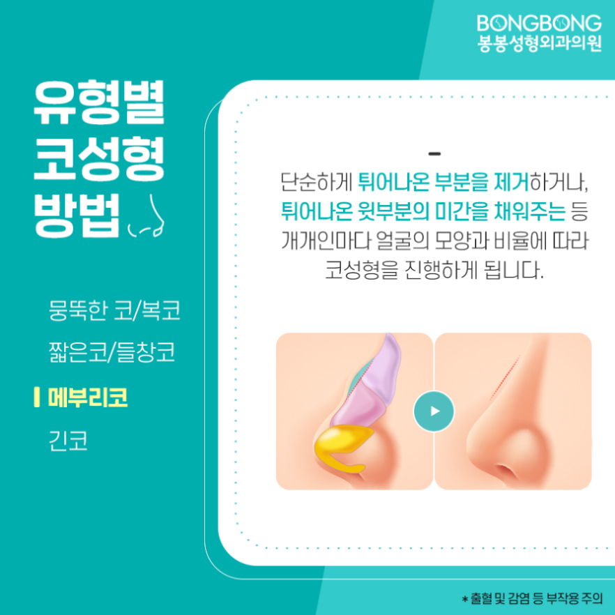 보형물과 자가조직을 더한 봉봉 하이브리드코성형수술이란? 관련 이미지 6