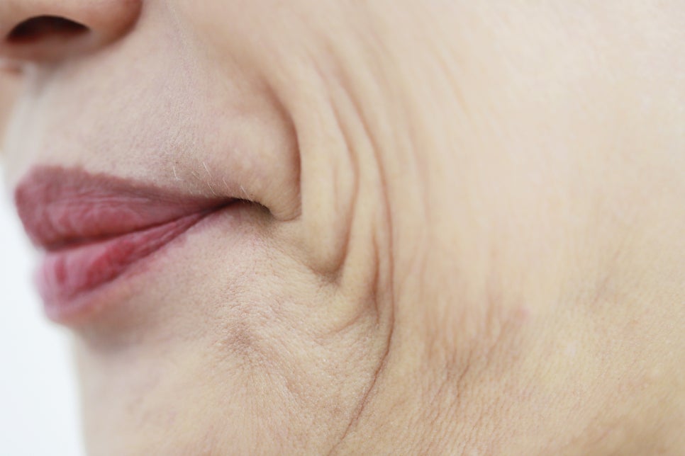 노안의 얼굴을 바꾸기 위해서는 안면거상술 관련 이미지 2