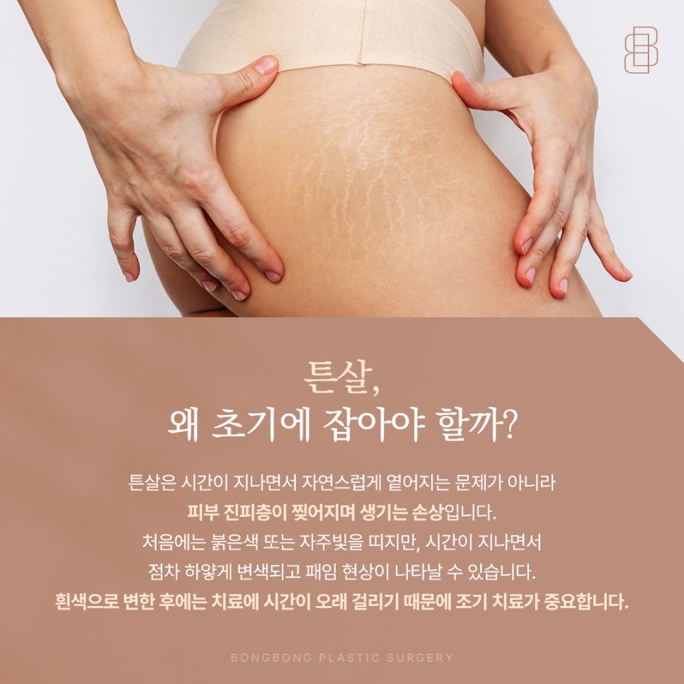 붉은 튼살 레이저 하얗게 변하기 전 매끄러운 피부를 되찾는 방법 관련 이미지 2