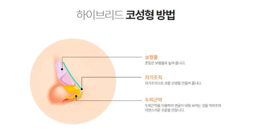 보형물과 자가조직을 더한 봉봉 하이브리드코성형수술이란? 관련 이미지 10