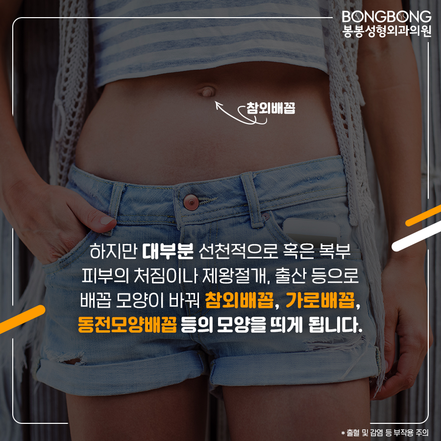 참외배꼽 콤플렉스라면 봉봉성형외과의 배꼽성형 관련 이미지 5