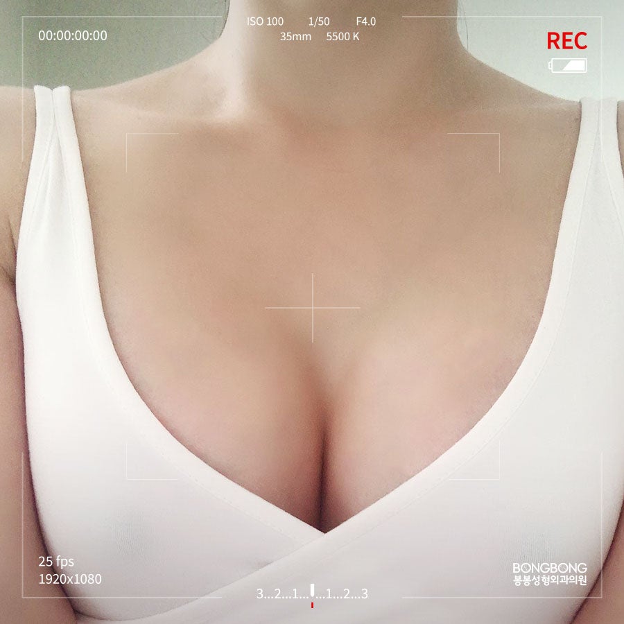 보형물 가슴성형 종류 내 체형에 맞는 것은? 관련 이미지 9