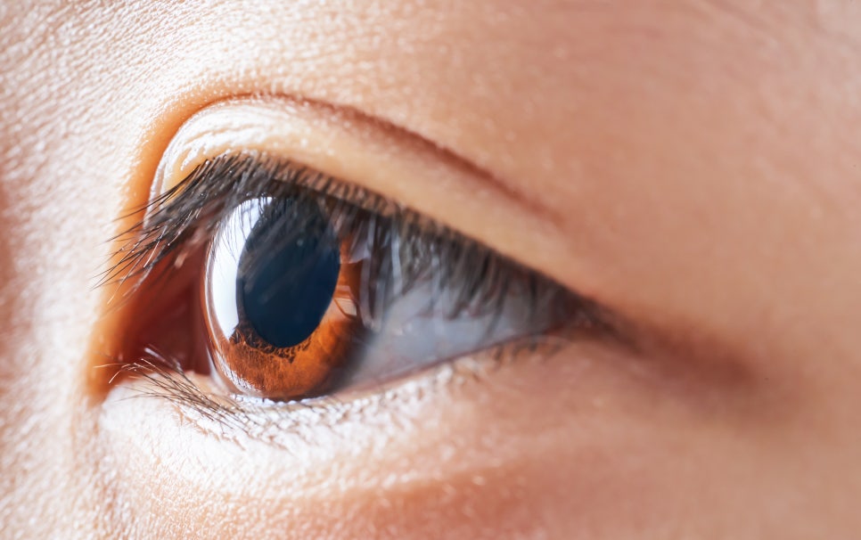 Ptosis Eye-Shape Correction Methods: What Is the Difference Between Incisional and Non-Incisional Techniques? image 2