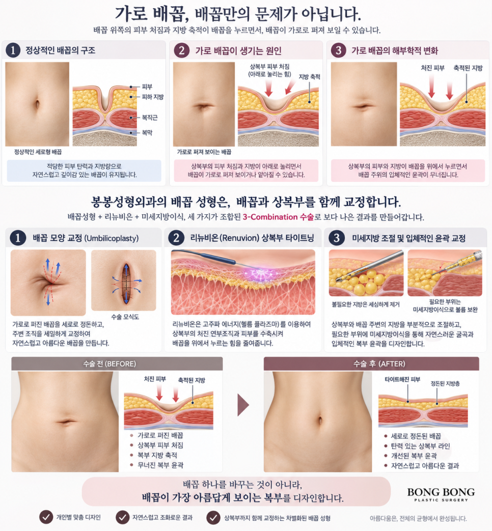 참외배꼽 그냥 둬도 될까 탈장과 구분하는 기준 관련 이미지 3