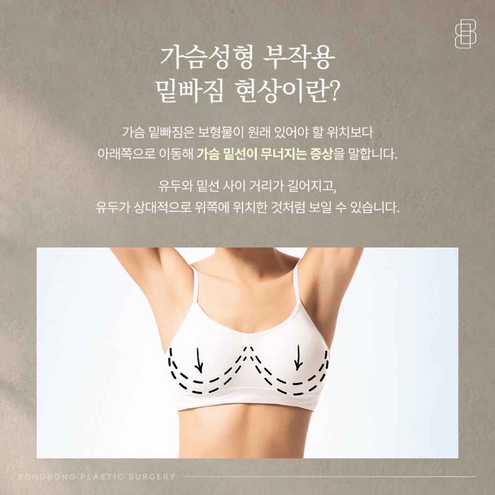 가슴 밑빠짐 모양 원인은? 보형물 공간을 딱 맞게 만들어야 하는 이유 관련 이미지 2