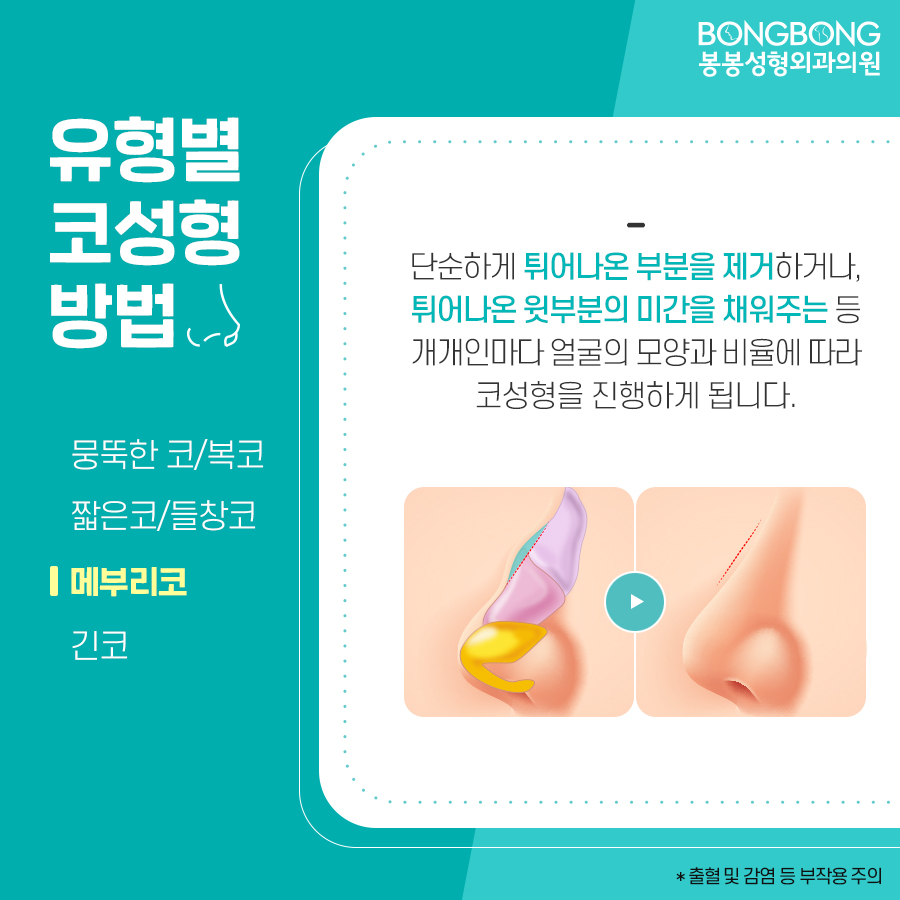 봉봉성형외과에서 설명하는 코성형방법/특징 관련 이미지 6