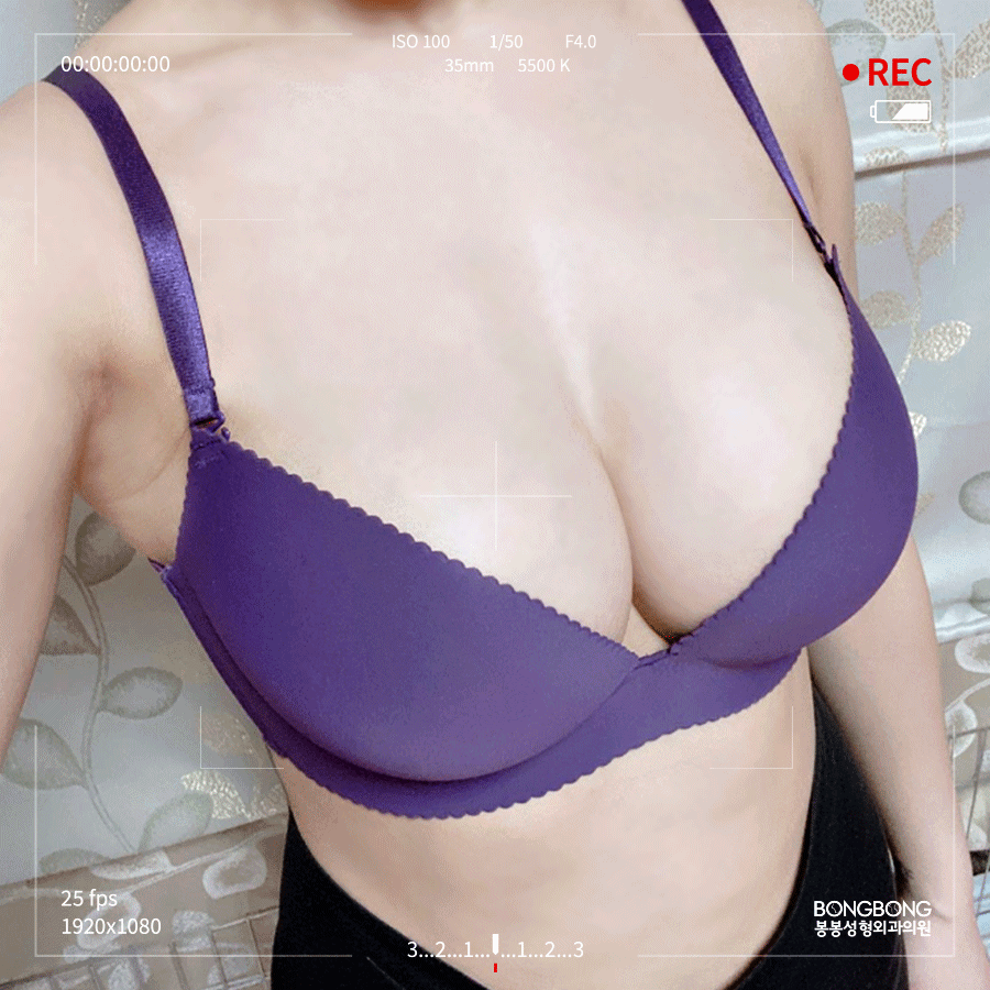 여자 부유방빼기, 제거술을 통해 개선 관련 이미지 4