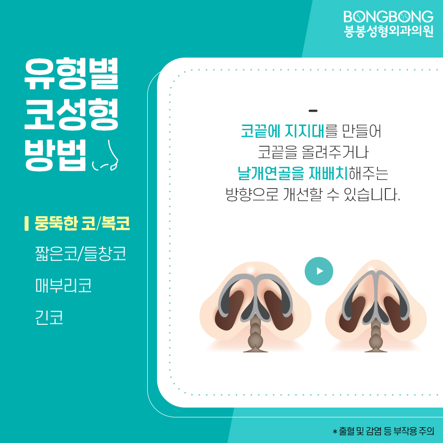 봉봉성형외과에서 설명하는 코성형방법/특징 관련 이미지 4