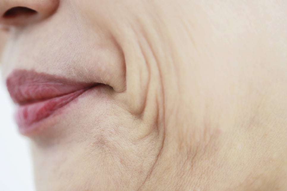 팔자주름, 처진 피부 개선 안면거상술 효과 관련 이미지 1