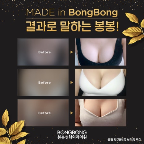 벌어진가슴 절벽가슴수술 #하이브리드가슴성형 으로 관련 이미지 8