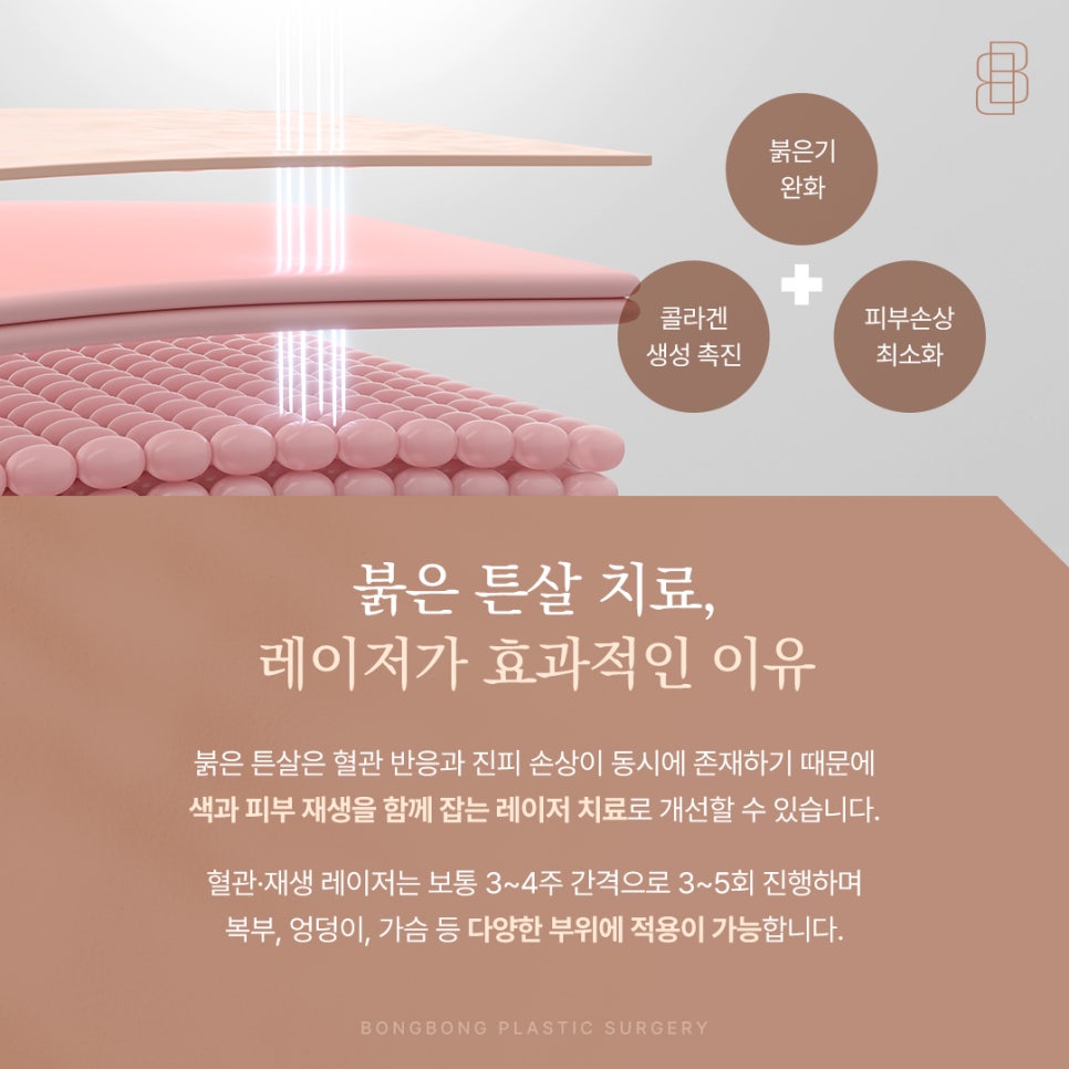 붉은 튼살 레이저 하얗게 변하기 전 매끄러운 피부를 되찾는 방법 관련 이미지 3