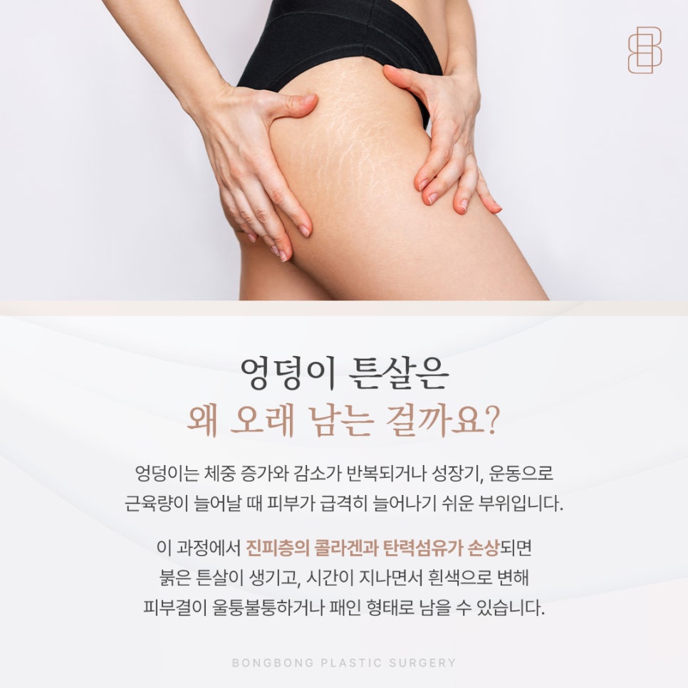 갑자기 찐 살로 생긴 엉덩이 튼살 미라젯으로 매끄러워질 수 있을까? 관련 이미지 2