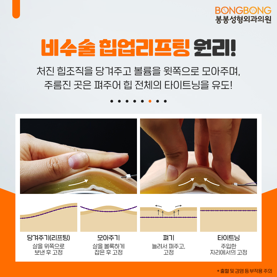 봉봉 비수술 <힙업리프팅>으로 볼륨감 있는 엉덩이 라인 만들기! 관련 이미지 4