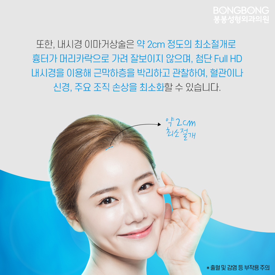 내시경이마거상술 효과는? 관련 이미지 6