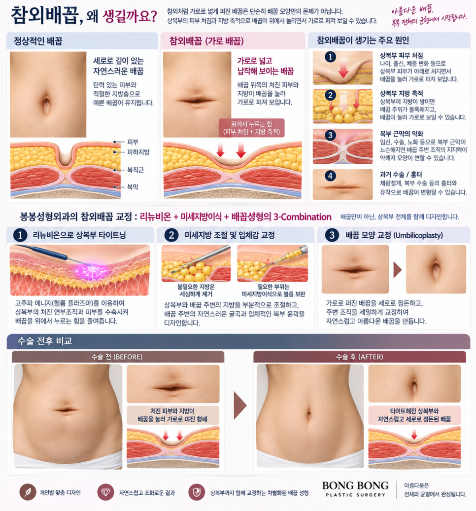 참외배꼽 그냥 둬도 될까 탈장과 구분하는 기준 관련 이미지 1
