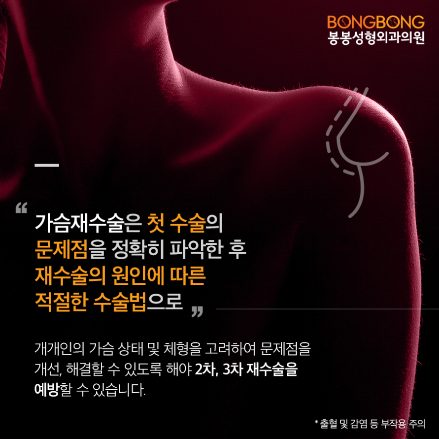 가슴재수술, 모티바 보형물이 효과적일까? - 봉봉성형외과 관련 이미지 5
