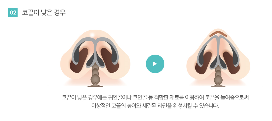 코끝성형후기 오똑한 콧날의 봉봉성형외과에서~ 관련 이미지 6