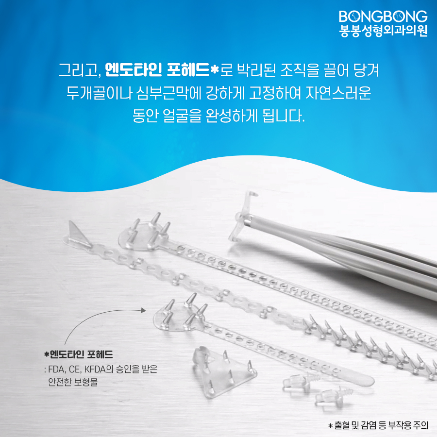 내시경이마거상술 효과는? 관련 이미지 7