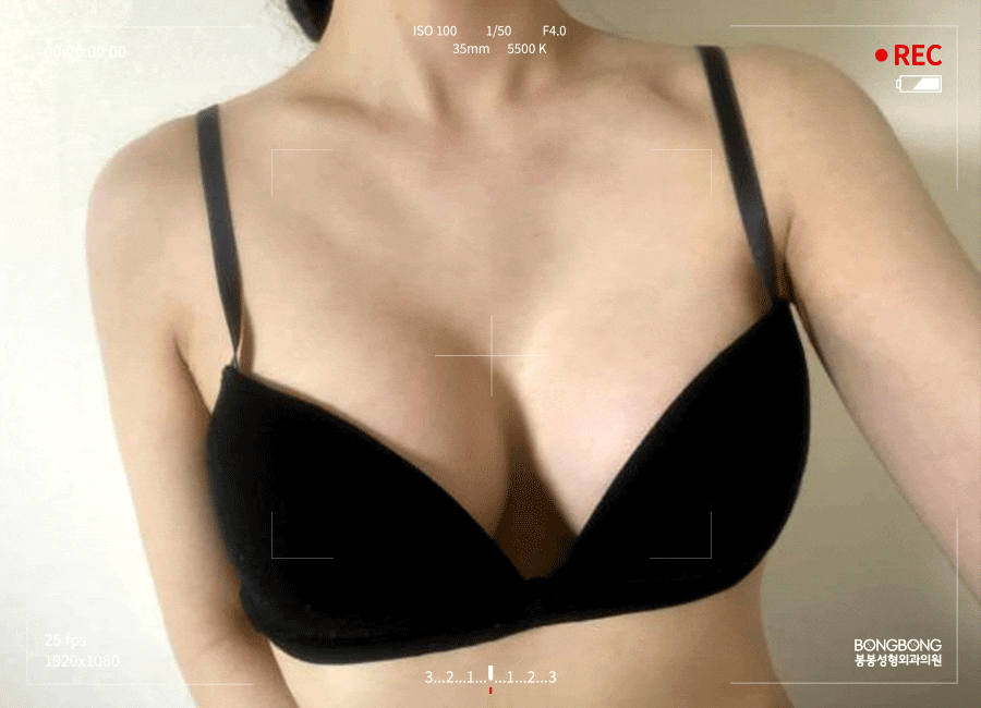 모티바 보형물 촉감이 좋은 이유는? 관련 이미지 4