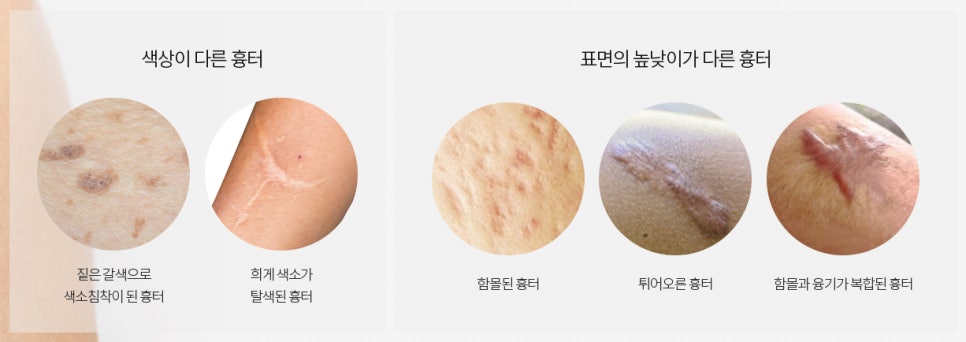 흉터 치료는 봉봉성형외과 스칼렛으로 어때? [스칼렛 패키지] 관련 이미지 3