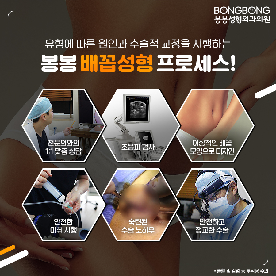 참외배꼽 콤플렉스라면 봉봉성형외과의 배꼽성형 관련 이미지 8