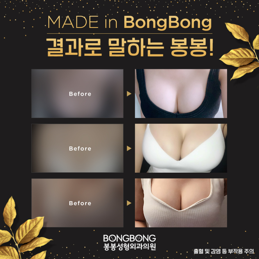 가슴성형 후 구형구축 [가슴재수술] 고려사항은? 관련 이미지 10
