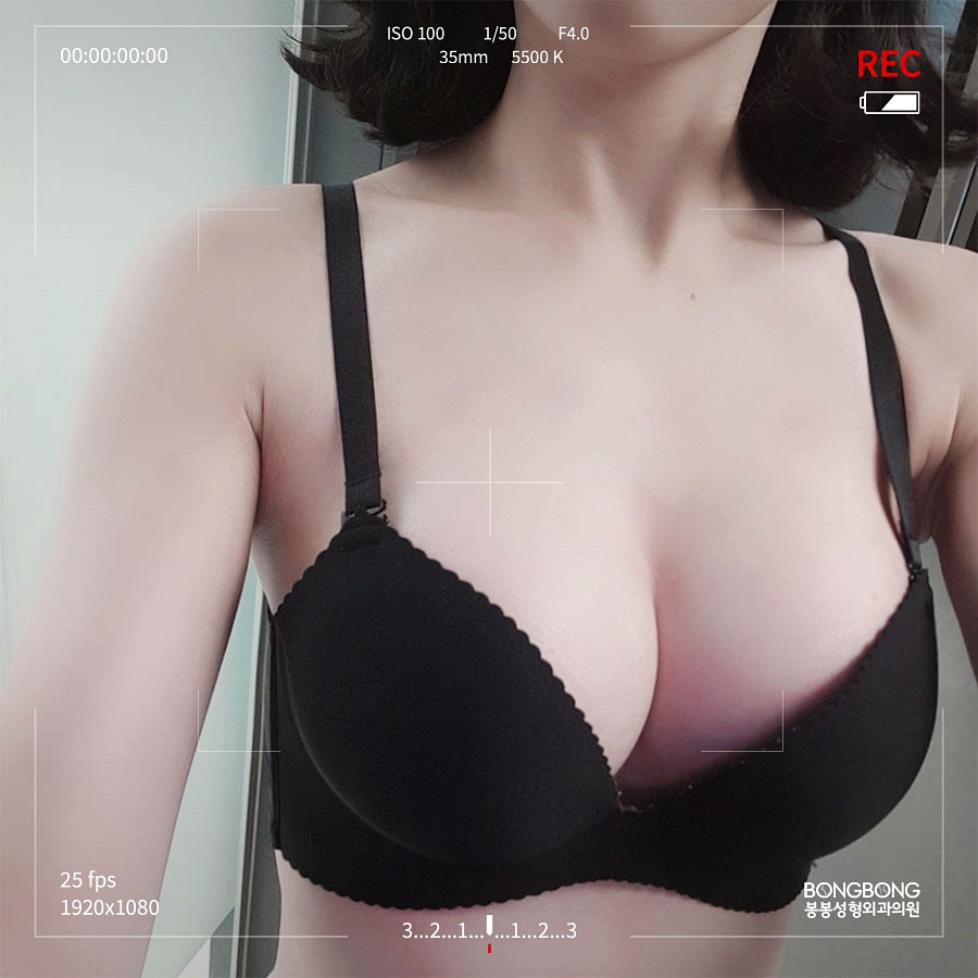 멘토 보형물성형, 절개법 종류 자연스럽고 안전하게 관련 이미지 4